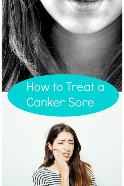 how to treat a canker sore